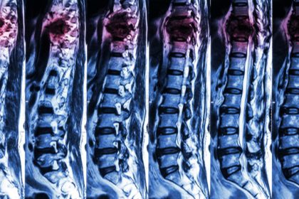 Spinal cord injury_Dietitians On Demand