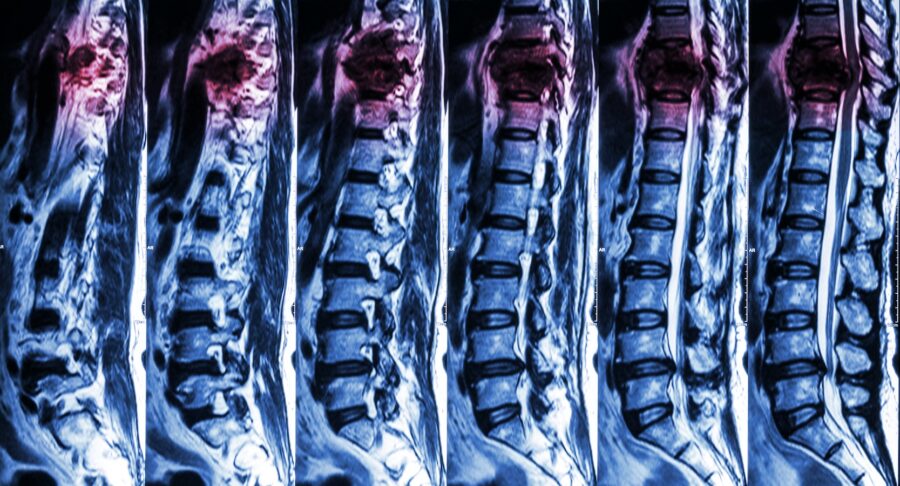 Spinal cord injury_Dietitians On Demand